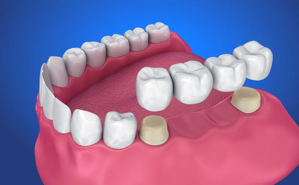 Dental Crown & Bridge